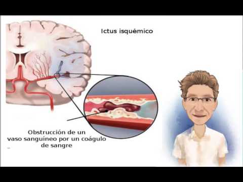 Vídeo: Accidente Cerebrovascular Talámico: Síntomas, Causas, Tratamiento, Recuperación, Pronóstico