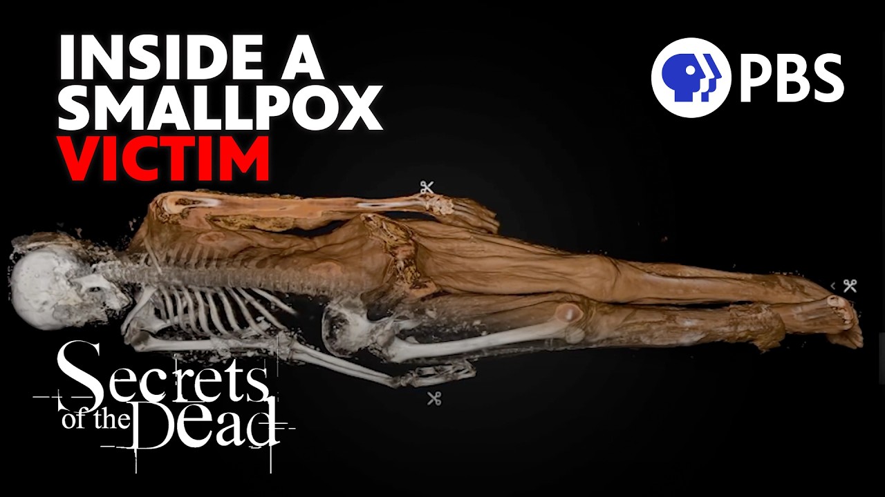Virtual autopsy on 150-year-old remains shows how smallpox colonizes