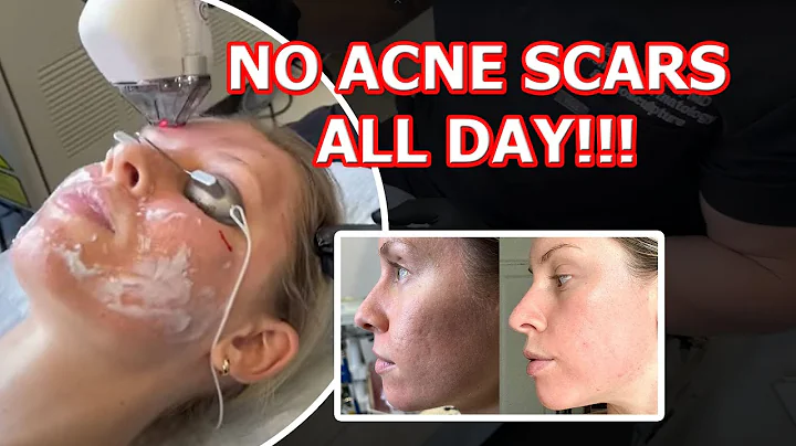Mantenha as cicatrizes de acne longe o dia todo com o laser Halo da Sciton