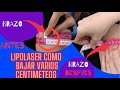 Como hacer Lipolaser para eliminar la grasa en brazos, antes y después