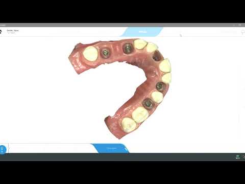 Intraoral Scanning Atlantis Abutments with CEREC PrimeScan