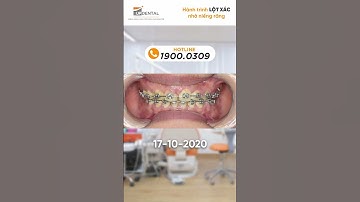 Hành trình LỘT XÁC nhờ niềng răng của Mỹ Lệ