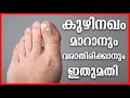 കുഴിനഖം മാറാനും വരാതിരിക്കാനും  |Home made Natural Toenail Fungus Remedies