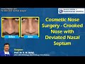 Cosmetic Nose Surgery - Crooked Nose with Deviated Nasal Septum