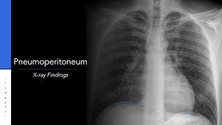 Pneumoperitoneum: Explanation of X-ray Findings