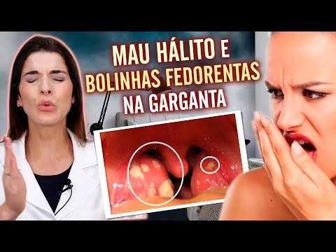 ACABE com as Bolinhas Fedorentas da Garganta e o MAU HÁLITO