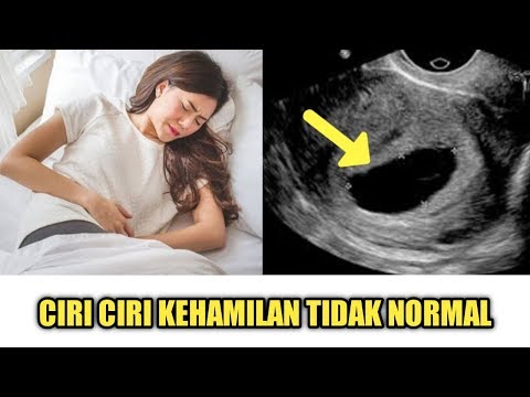 Video: Ibu Nyata Berbagi Mengejutkan, Namun Normal, Gejala Kehamilan