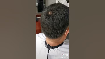 Cách chữa hói đầu