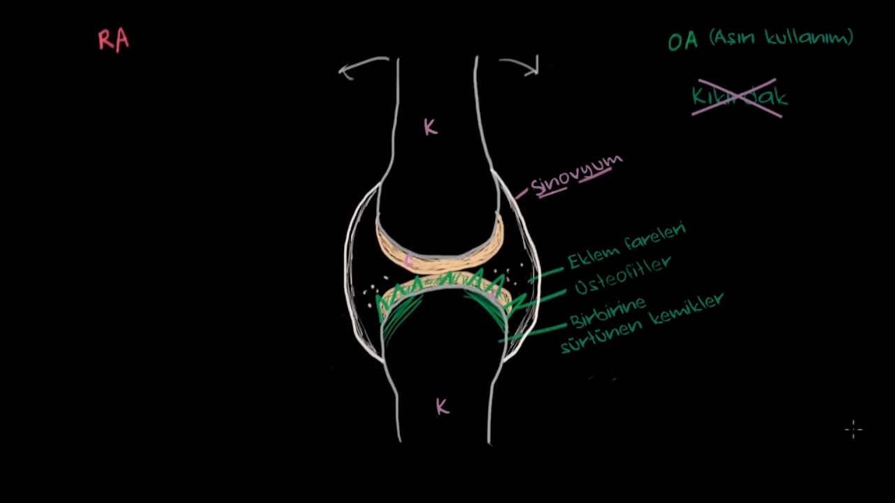 Osteoartrit ve Romatoid Artrit Patofizyolojisi (Fen Bilimleri) (Sağlık ve Tıp)