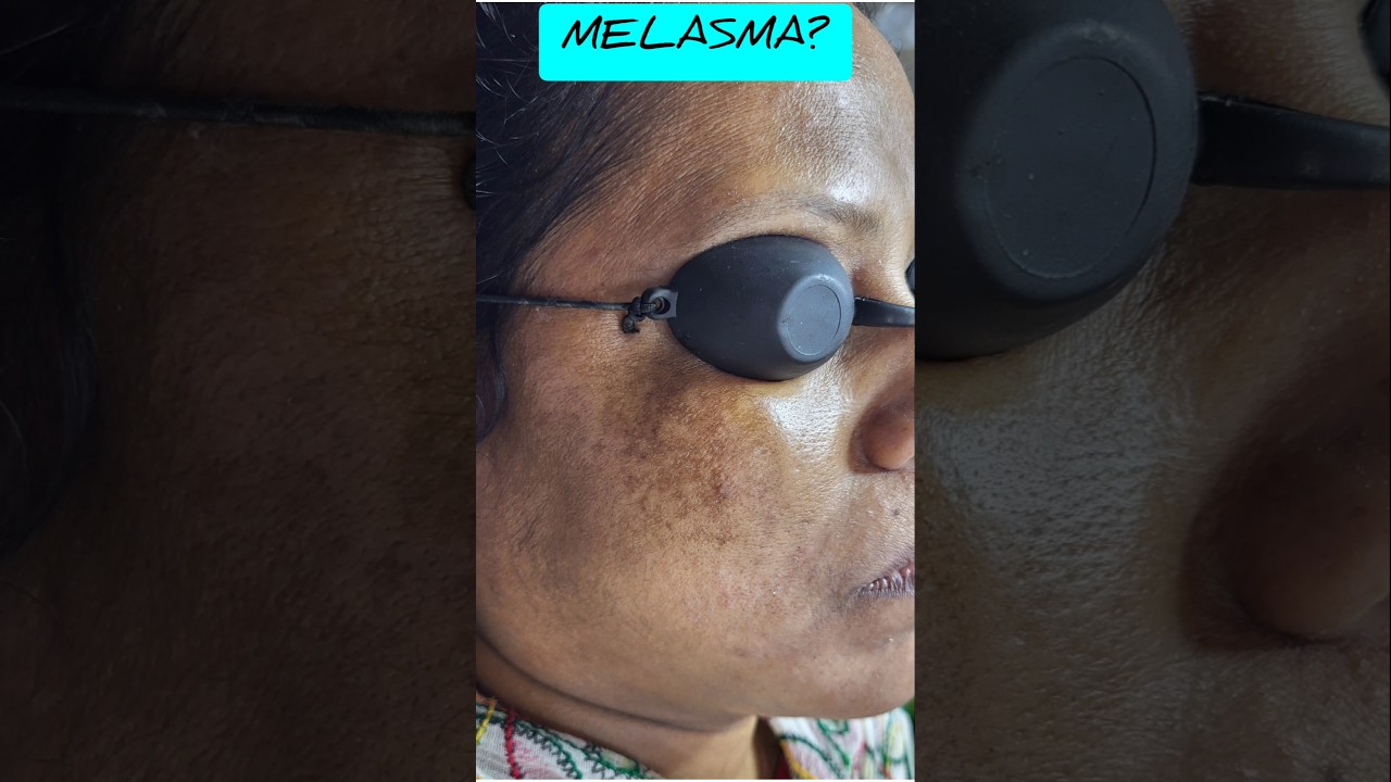 Laser treatment for melasma #ndyag #melasma #drgsmukherjee #pigmentation #darkspots #laser Laser treatment for melasma #ndyag #melasma #drgsmukherjee #pigmentation #darkspots #laser