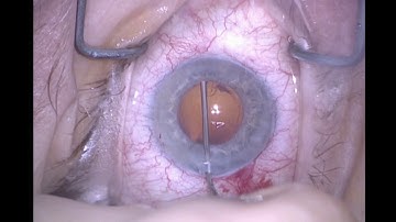 Phaco With Zonulopathy | Advanced IOL Fixation Techniques, edited by David F. Chang, MD