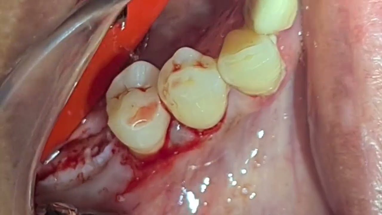 Tissue Level Implant Palcement: Dentium Simple Line: Single Stage