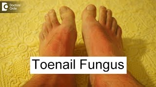 5 Ayurvedic proven ways to manage toenail fungus - Dr. Prashanth S Acharya