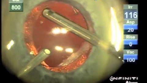 Membrane Optic Capture of a Dislocated Sulcus IOL