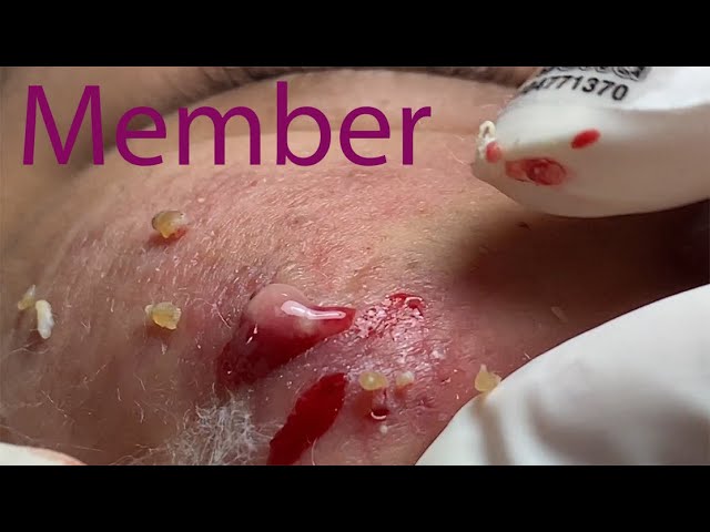 Acne Treatment Huong Da Nang# 024 |  fans membership