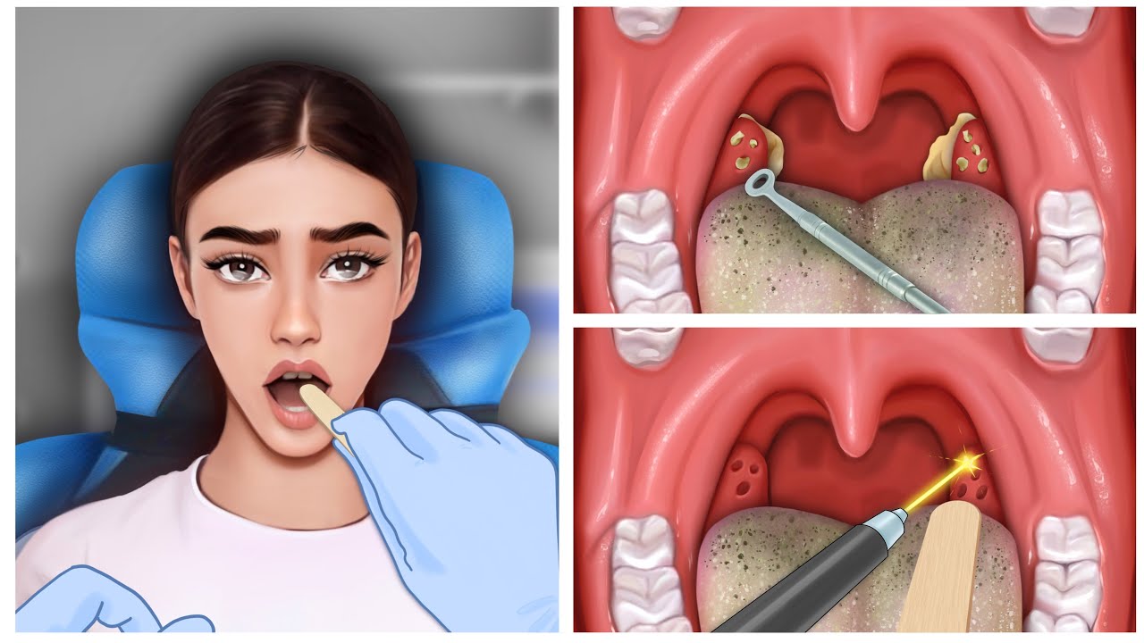 ASMR satisfying tonsillitis & tonsil stone removal animation / asmr扁桃石