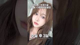눈코윤곽수술 후기 #shorts