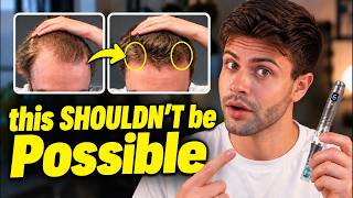 This is HOW the Derma Pen REGROWS HAIR