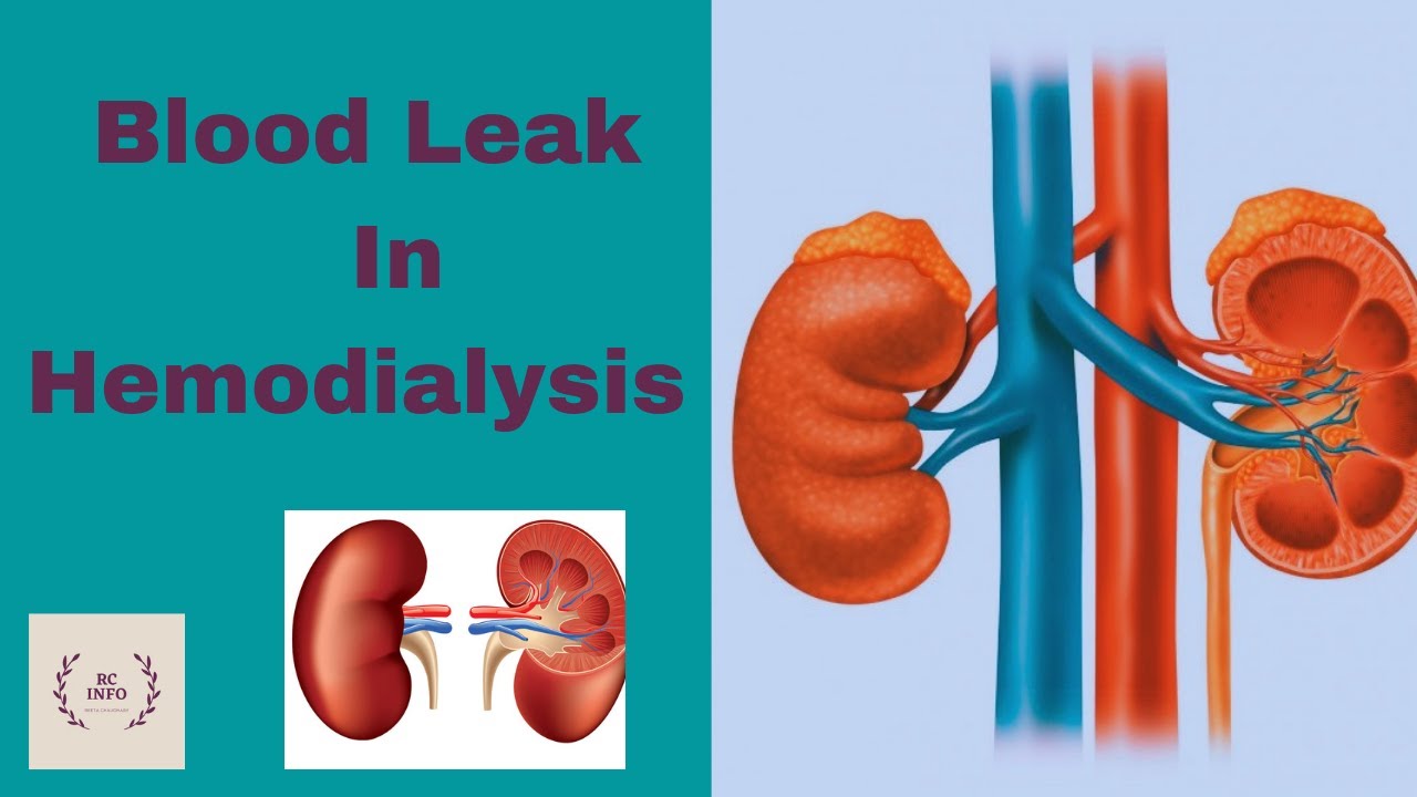 Blood leak in of hemodialysis / Blood leak/ Blood leak in dialysis