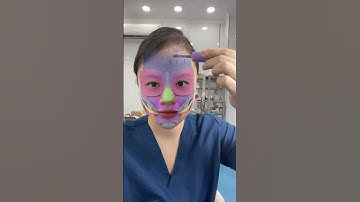 HƯỚNG DẪN XÁC ĐỊNH ĐIỂM TIÊM BOTOX XOÁ NHĂN TRÁN