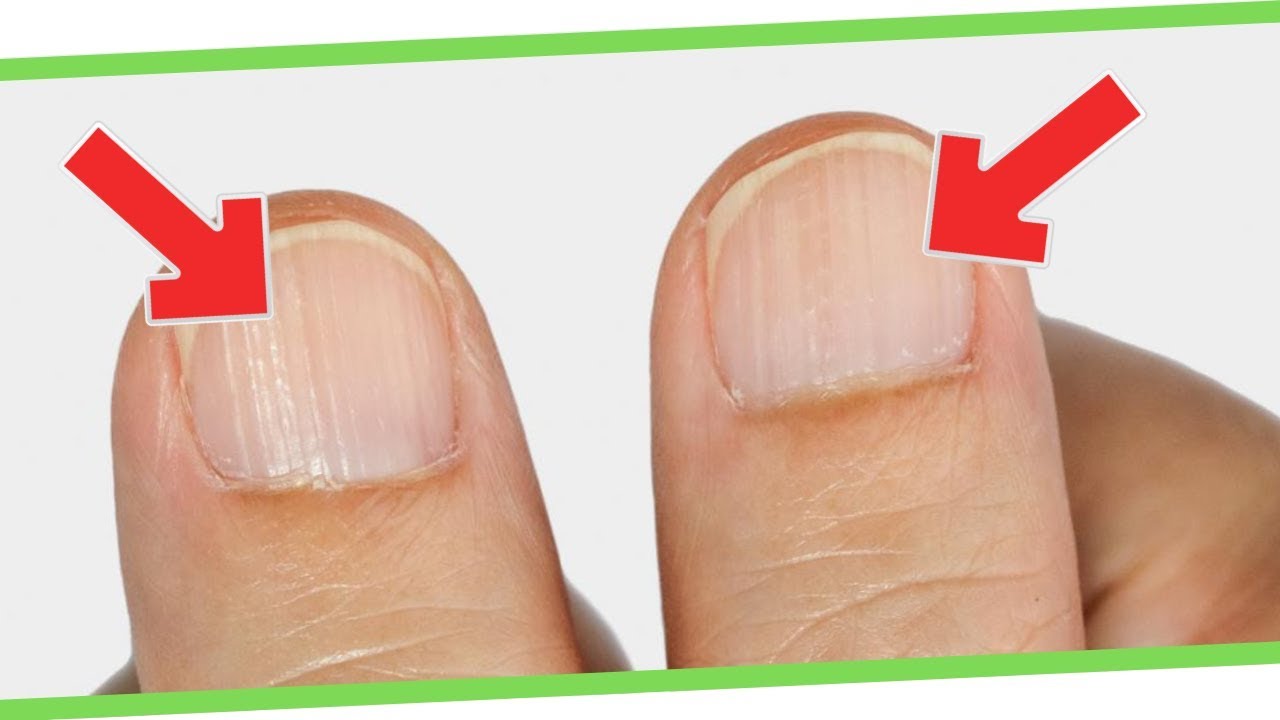 What Ridges In Finger And Toenails Mean For Your Health - YouTube