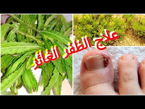 عشبة مكرمان الطيون او ترهلا مضاد حيوي طبيعي طريقة علاج الظفر الغائر في اللحم بهذه النبتة