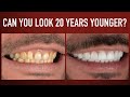 Can You Look 20 Years Younger? - Full Mouth Restoration Case