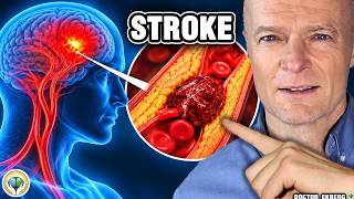 #1 Best Way To Prevent A Stroke