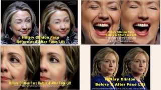 Hillary Clinton Face Before and After Face Lift #480 np