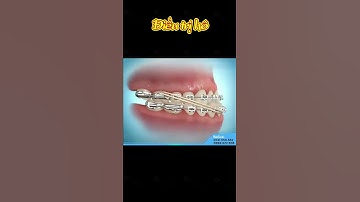 [3D] ĐIỀU TRỊ HÔ || Nha Khoa Quốc Tế Athena