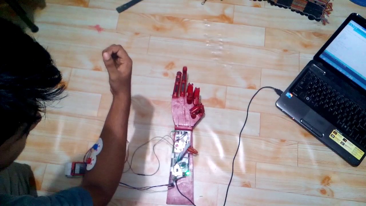 Myoelectric prosthetic arm YouTube