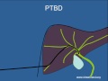 Biliary Stenting