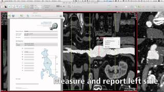 AAA Sizing with aycan OsiriX PRO