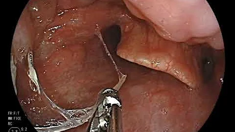 fish bone stabbing in tonsil鱼刺卡在喉咙(维登诊所韦伊凡医师) - 天天要闻