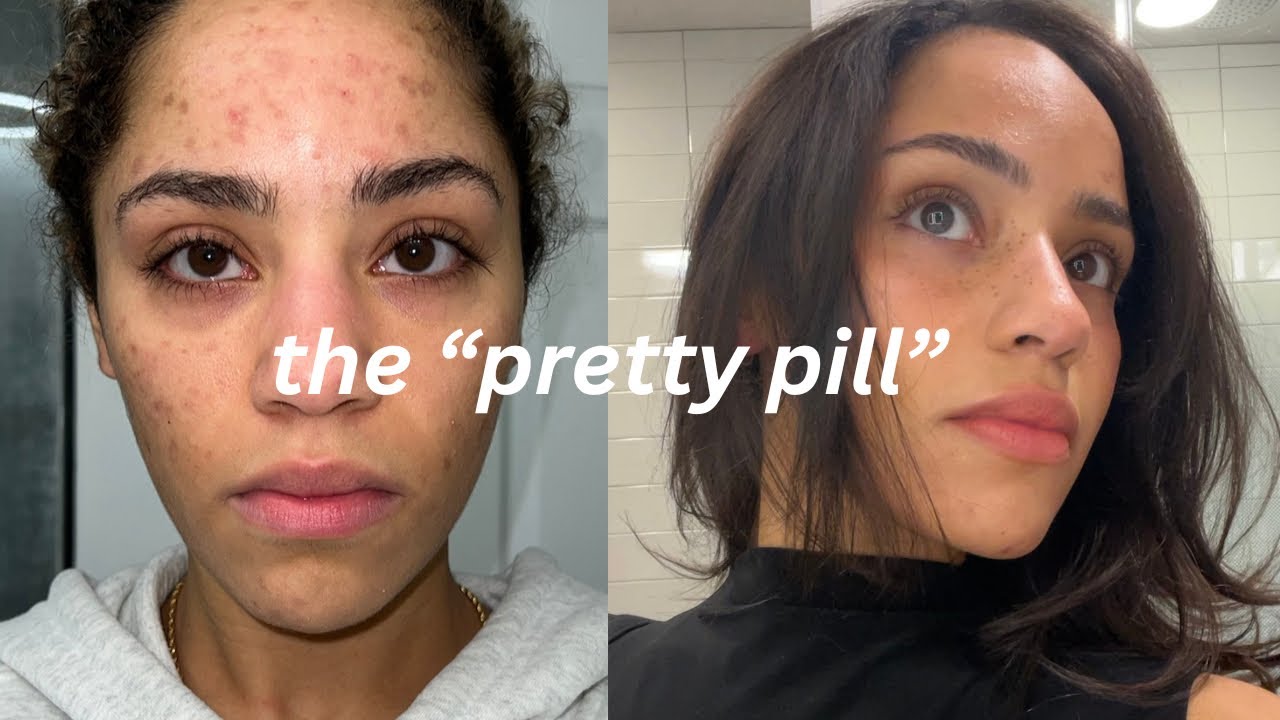 SPIRONOLACTONE experience- the “pretty pill” before & after, side effects, what they don’t tell you