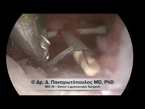 Lost IUD (Mirena®) - Υστεροσκοπική Αφαίρεση