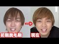 【ハゲ日記】AGA薄毛治療16ヶ月目【クリニック編】