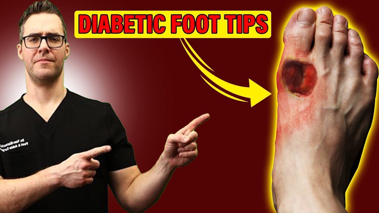 Diabetic Foot Ulcer & Foot Wound 101! [STOP Diabetic FOOT Infections]