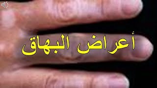 اعراض البهاق يوتيوب