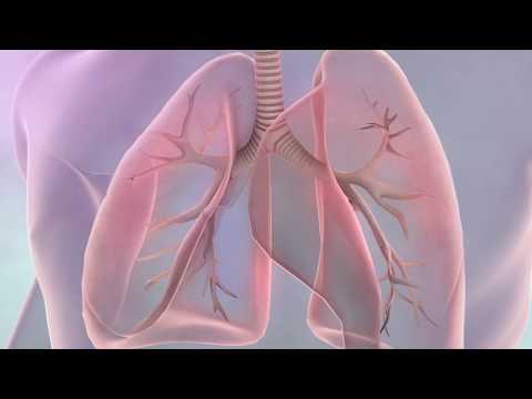 Video: Lungcancer - Behandling, Symtom, Stadier