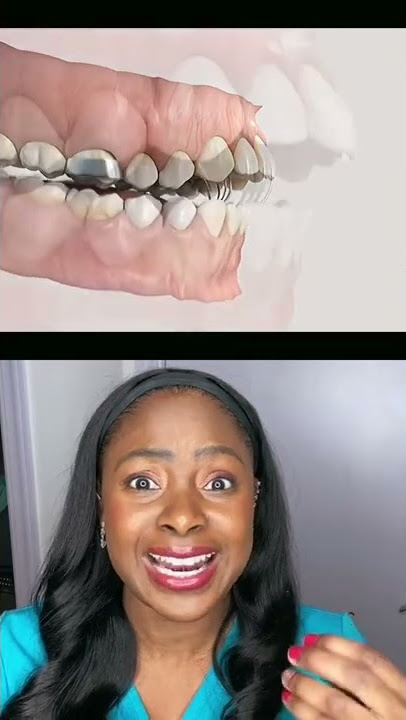 How to stub tongue thrusting and thumb sucking #shorts #teeth