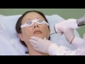 Melasma Treatment by Amara Medical aesthetics in Bellevue