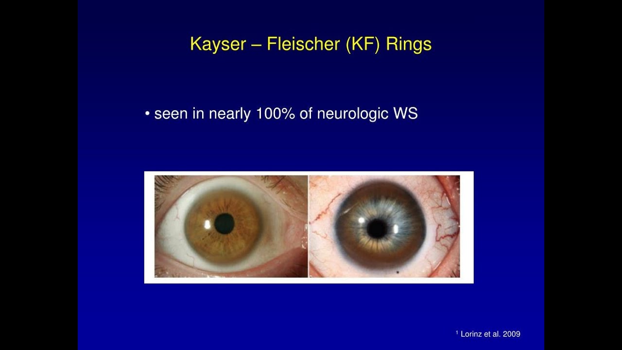 kayser-fleischer-rings-definition-appearance-associated-conditions