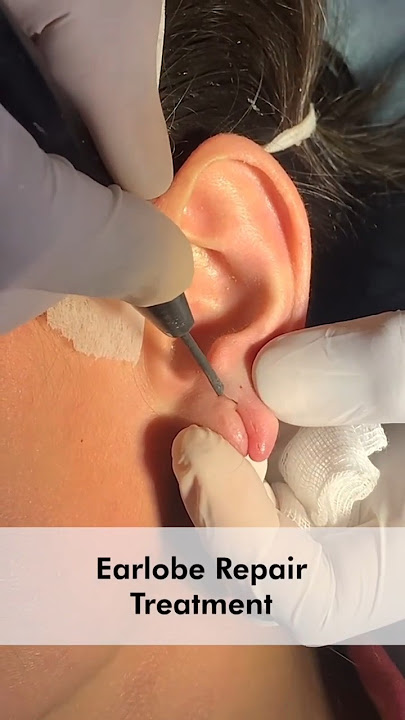 Suture-Free Ear Lobe Repair at Skinaa Clinic