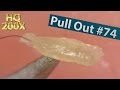 #74 Pull Out Blackheads Close up 200X - Blackheads Removal