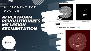 AI Platform Revolutionizes MS Lesion Segmentation, Empowering Doctors with Advanced Diagnosis Tools