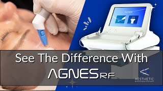 The Benefits of AGNES RF | How does Precision RF Microneedling Work?