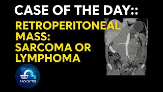 Case of the Day [Retroperitoneal mass:: Sarcoma or Lymphoma] screenshot 4