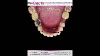 درمان ارتودنسی ثابت دو فک همراه با کشیدن دندان | کلینیک تخصصی دندانپزشکی کانسپتا