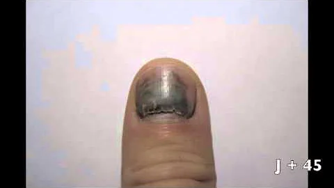 Comment Repousse Un Ongle Noir Comment Repousse Un Ongle Noir